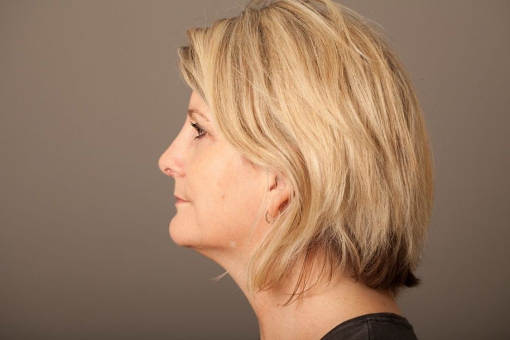 Dorsal Hump (Nose Bumps) Causes & Removal Options