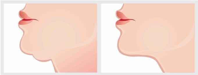 before and after chin surgery