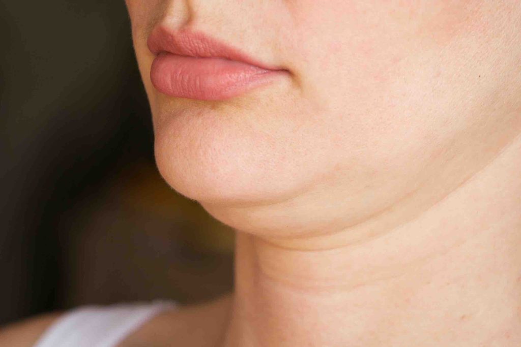 double-chin-liposuction-brisbane