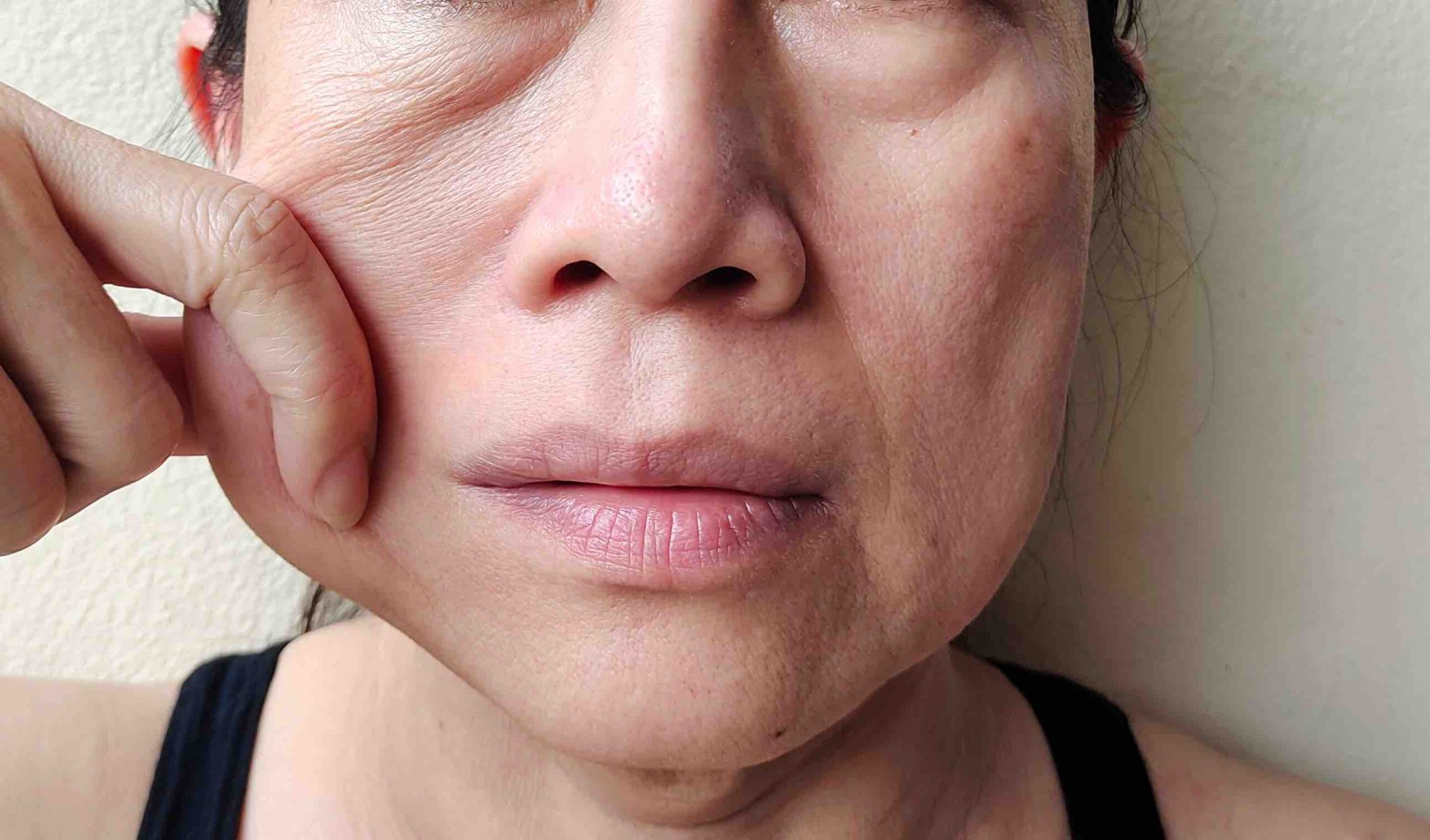 The Ultimate Facial Skin Tightening Treatments Gold Coast Specialist