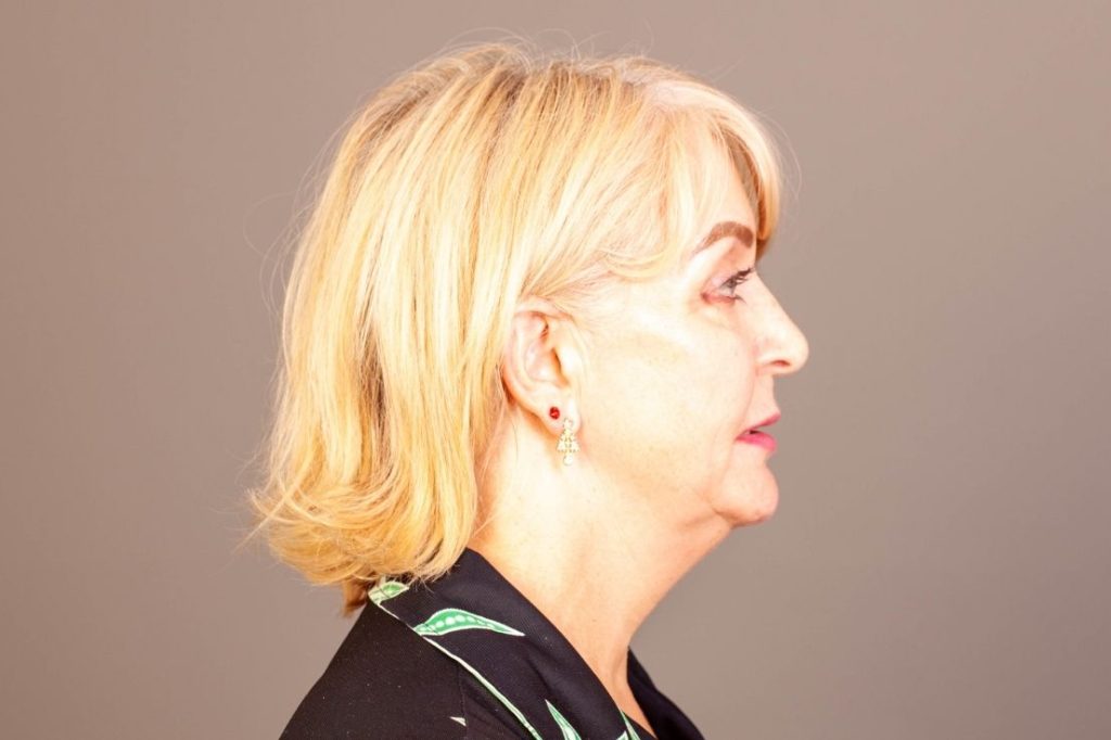 How to Get Rid of Turkey Neck Dr. Mark Doyle