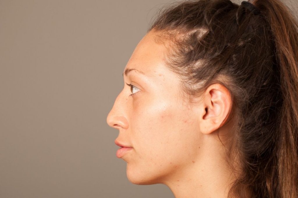 Dorsal Hump (Nose Bumps): Causes & Removal Options