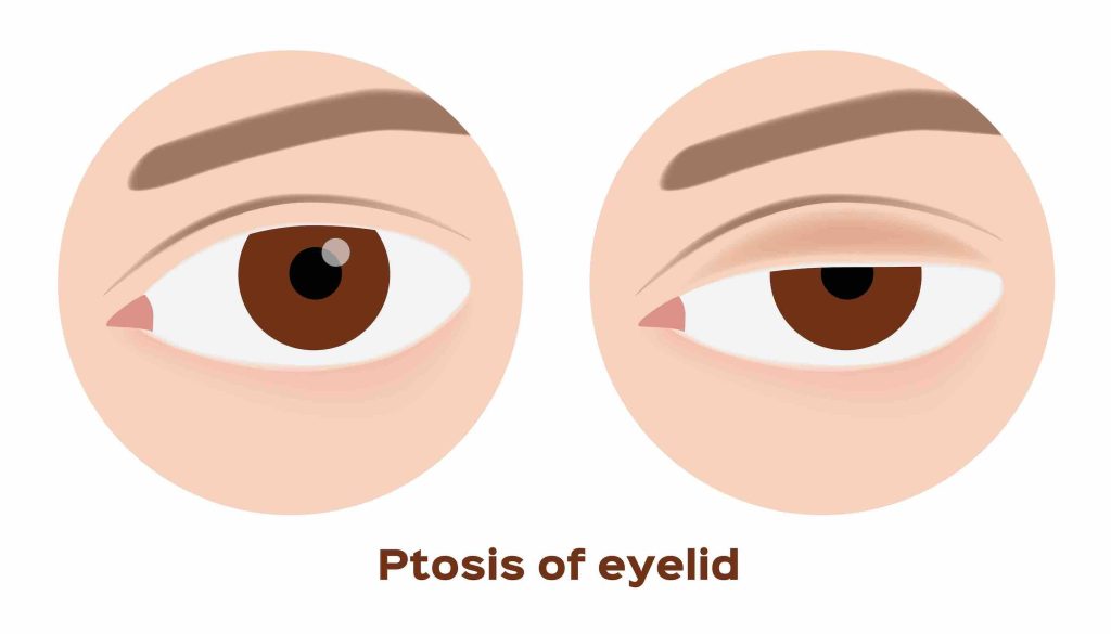ptosis-of-the-eyelid