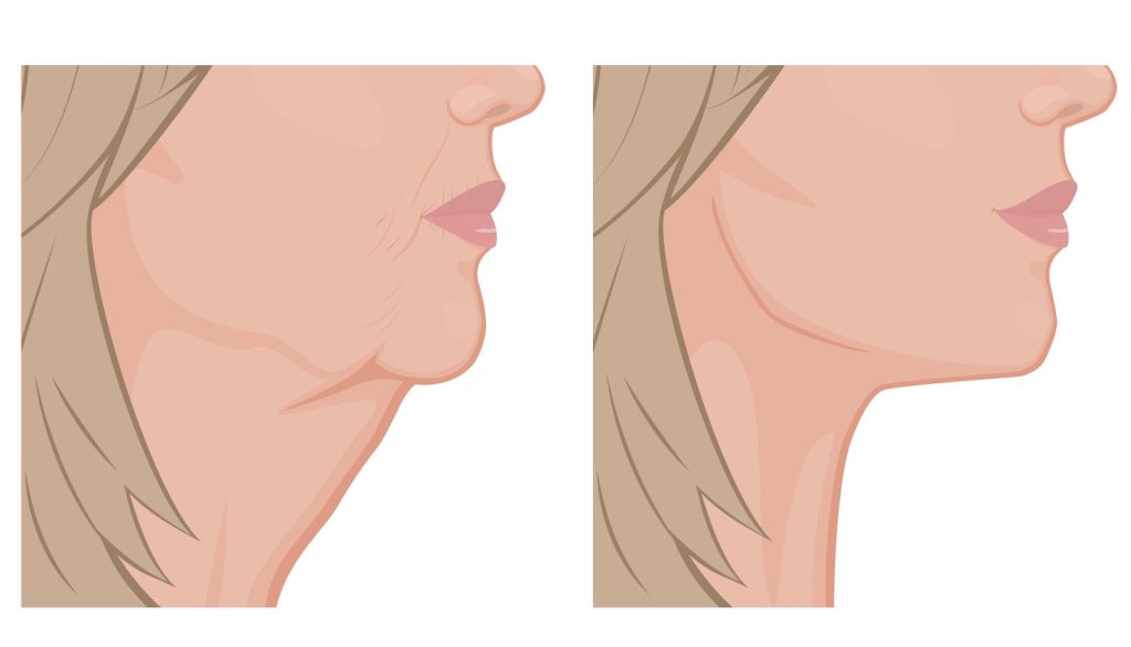 surgery to tighten neck skin