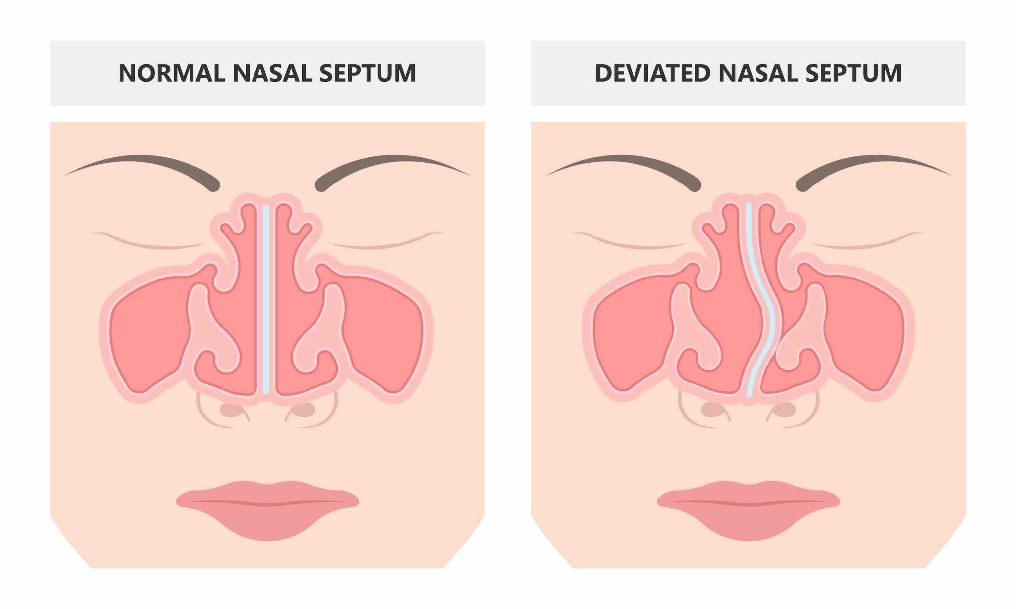 Deviated Septum Self Test Know If You Have A Deviated Septum 6349