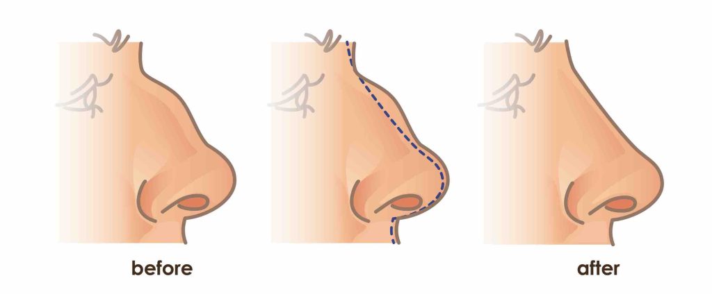 different types of nose shapes