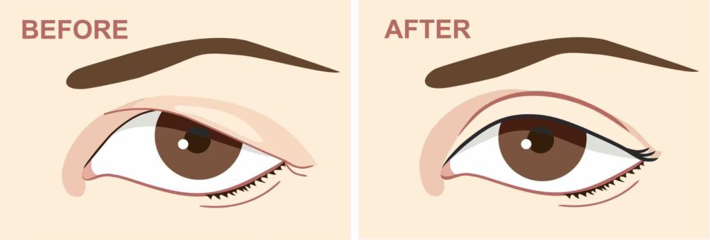 Blepharoplasty Medicare Qualify For Eyelid Surgery Medicare Rebate