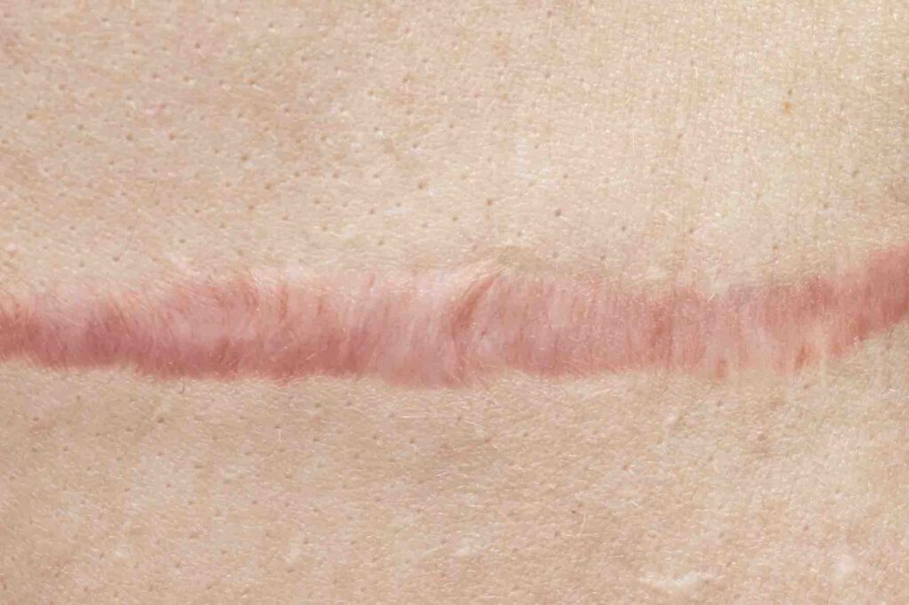 keloid-scar