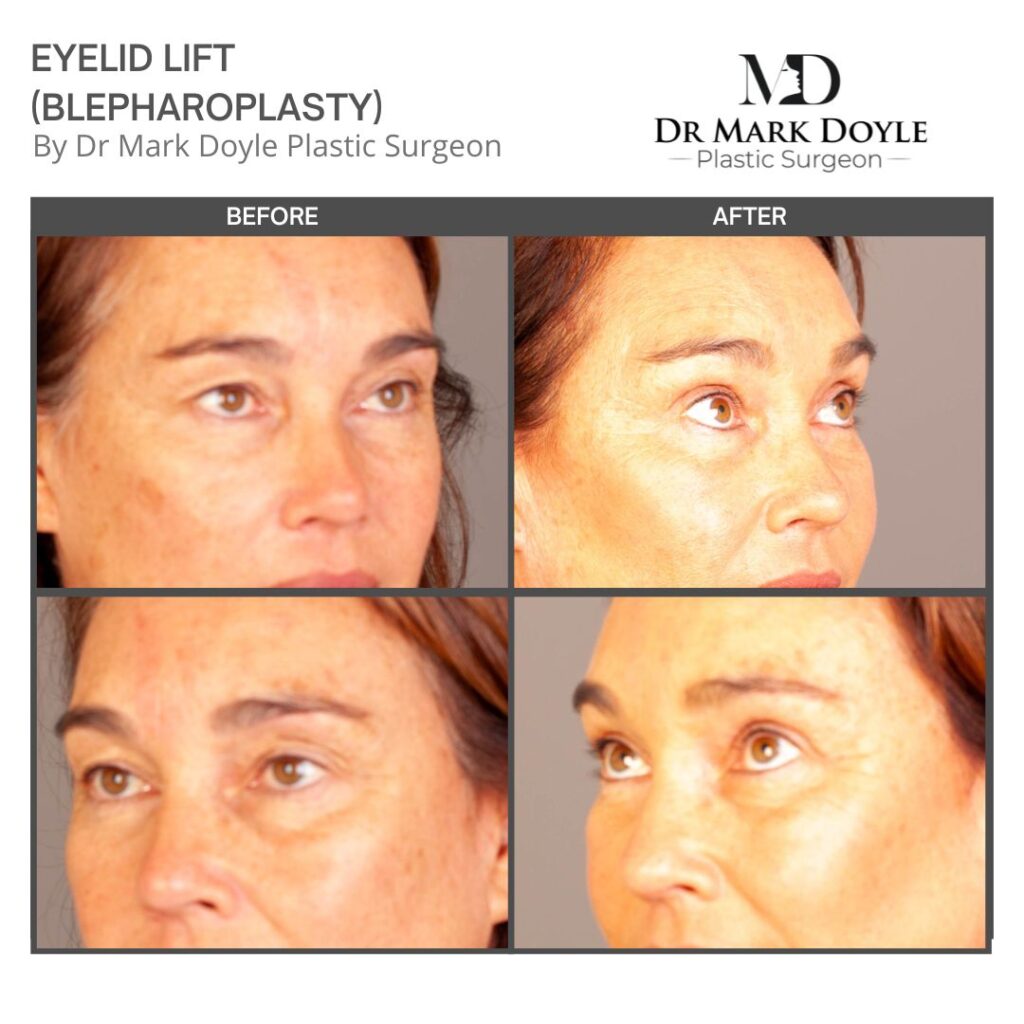 recovery from blepharoplasty