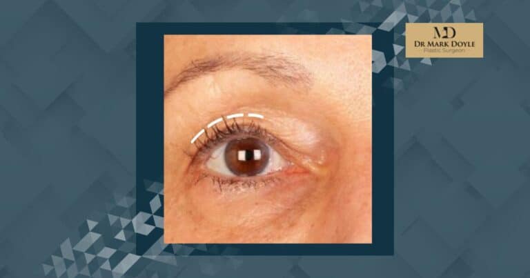 Blepharoplasty Recovery And Scarring Dr Mark Doyle